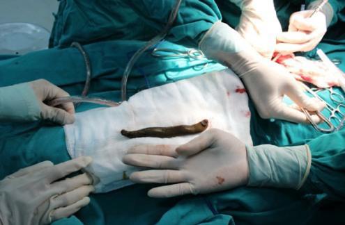 Dich vu bao ve uy tin | Đỉa 20 cm sống trong bàng quang bé trai